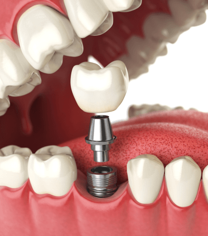 Dental implants