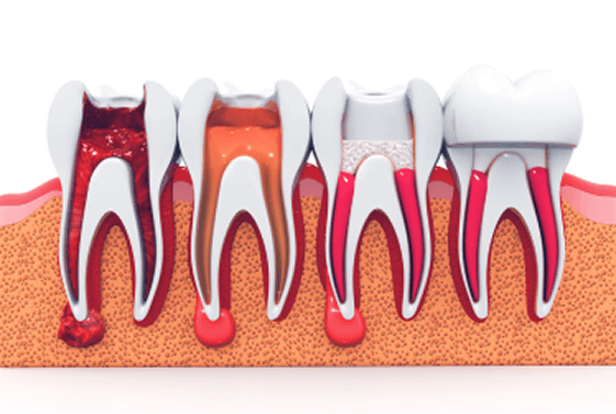 Root Canal Treatment